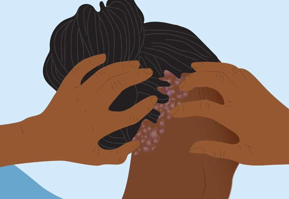 treating-Hair-dandruff